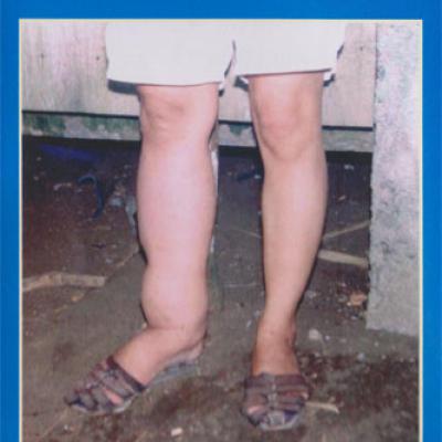 हात्तिपाइले रोग (lymphatic filariasis)